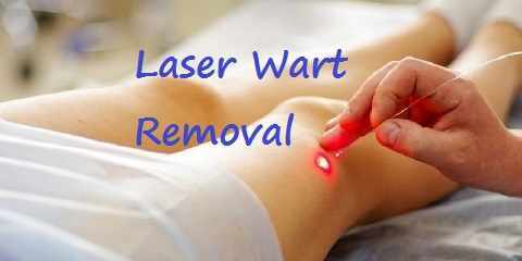 laser wart removal