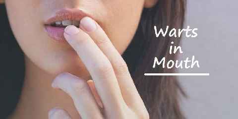 warts in mouth