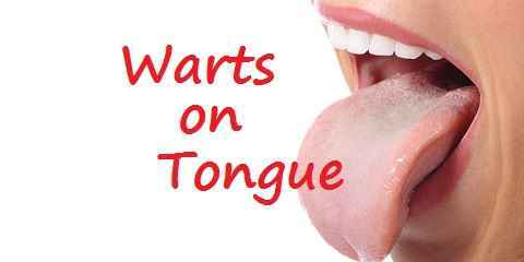warts on tongue